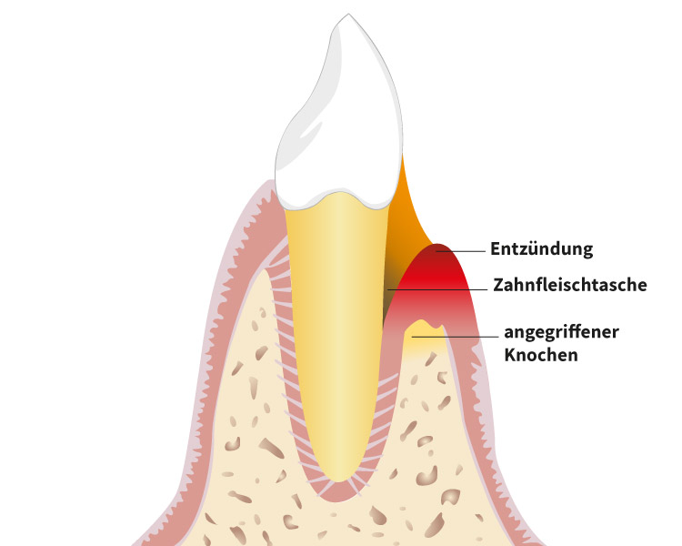 Parodontitisbehandlung