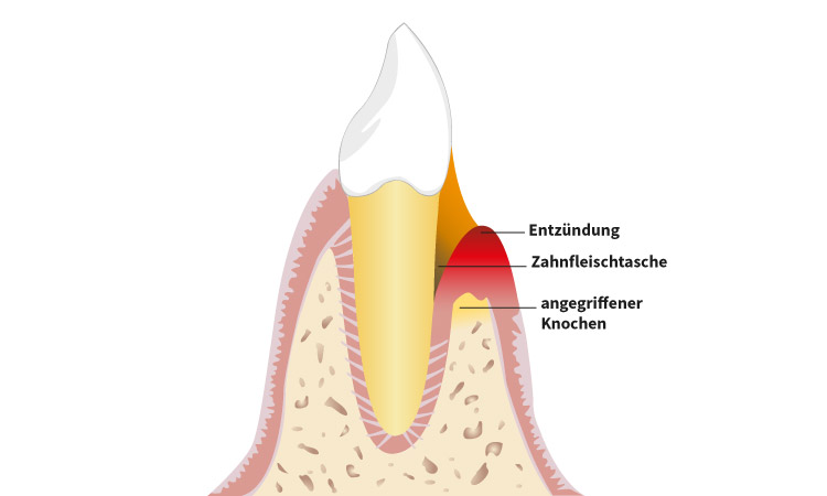 Parodontitisbehandlung